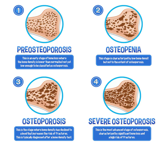 Bone Density & Osteoporosis Risk